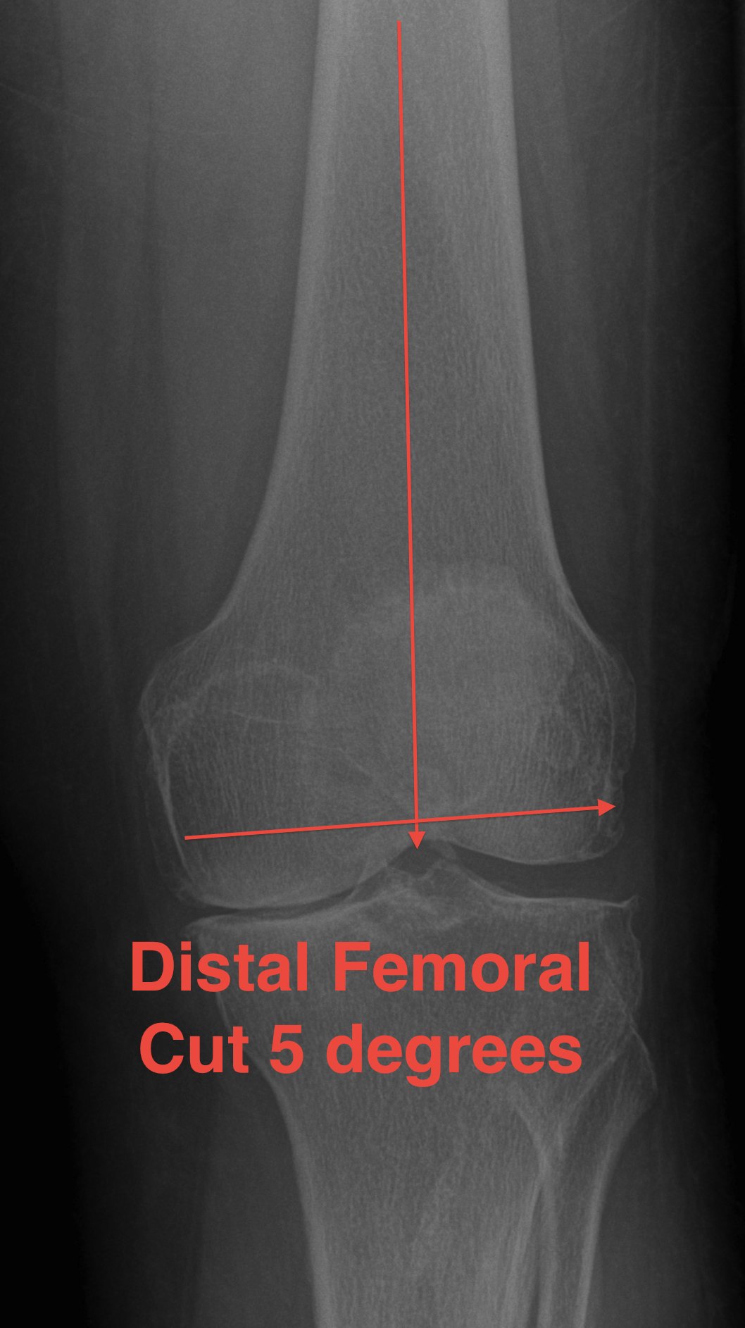 TKR Distal Femoral Valgus Cut